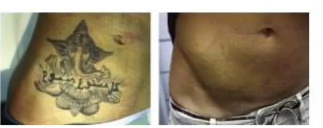 Före- och efterbild på tatueringsborttagning