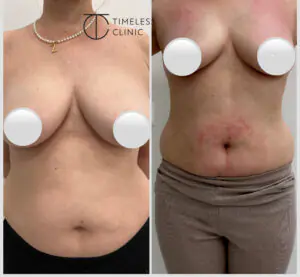 exilis
